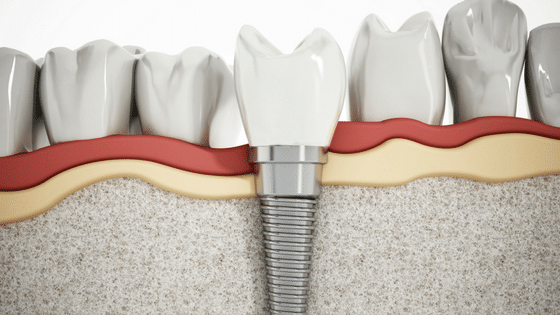 Dental Implants: An Overview Dental Implants in Orem Crawford Leishman Dental dentist in Vineyard Utah Dr. Chris Crawford Dr. Rick Leishman Dr. Matt Fletcher Crawford Leishman Dental dentist in Vineyard Utah Dr. Chris Crawford Dr. Rick Leishman Dr. Matt Fletcher