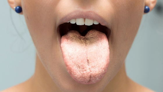 What Your Tongue Says About Your Health Crawford Leishman Dental dentist in Vineyard Utah Dr. Chris Crawford Dr. Rick Leishman Dr. Matt Fletcher