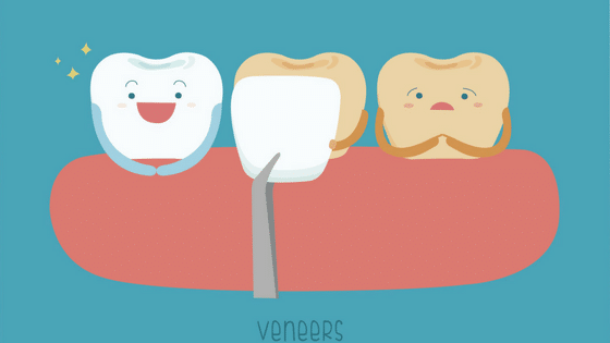 What Are The Benefits of Veneers? Crawford Leishman Dental dentist in Vineyard Utah Dr. Chris Crawford Dr. Rick Leishman Dr. Matt Fletcher