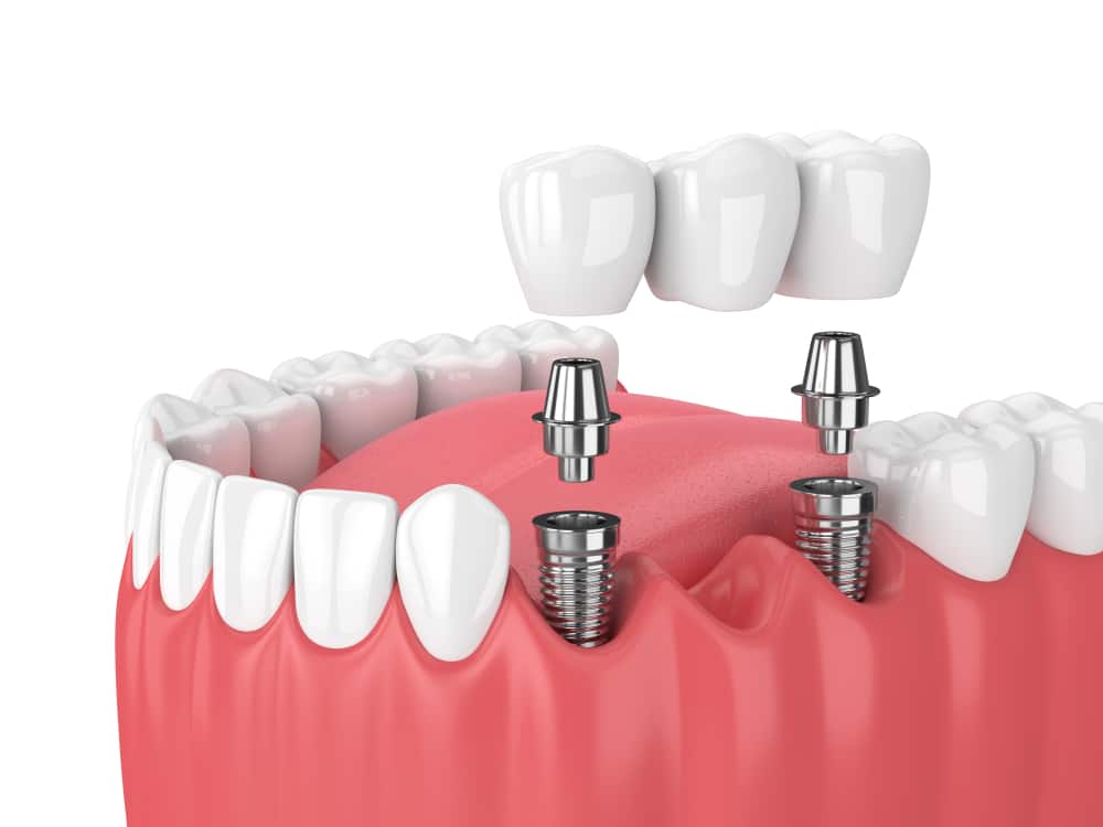 What Happens in a Dental Bridge Procedure? Crawford Leishman Dental dentist in Vineyard Utah Dr. Chris Crawford Dr. Rick Leishman Dr. Matt Fletcher