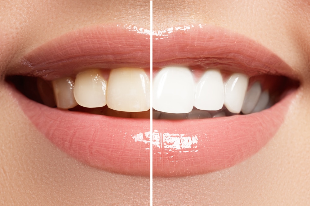 When to Choose Professional Teeth Whitening Over DIY Options Crawford Leishman Dental dentist in Vineyard Utah Dr. Chris Crawford Dr. Rick Leishman Dr. Matt Fletcher