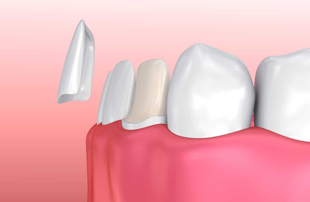 How Porcelain Veneers Compare to Other Types of Veneers Crawford Leishman Dental dentist in Vineyard Utah Dr. Chris Crawford Dr. Rick Leishman Dr. Matt Fletcher