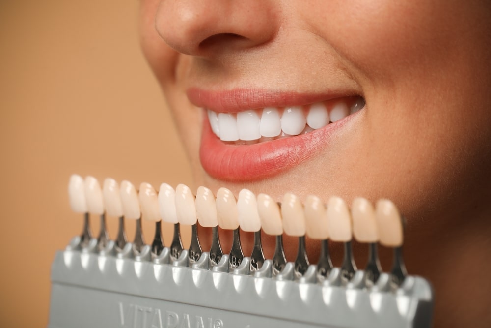 benefits of veneers Utah City